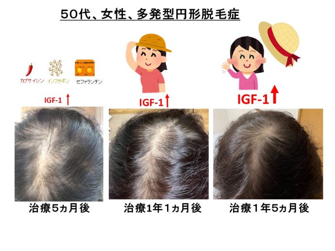 円形脱毛症　病院